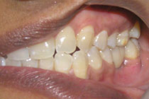 Single Tooth Implant