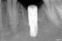 Single Tooth Implant