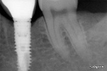 Single Tooth Implant