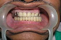 Single Tooth Implant