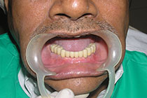 Single Tooth Implant