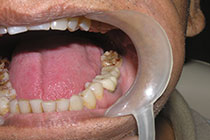 Single Tooth Implant