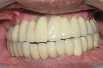 Single Tooth Implant