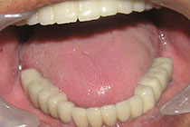 Single Tooth Implant