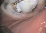 dental decay