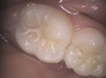 pit and fissure sealants