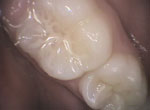 pit and fissure sealants