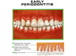 early periodontis